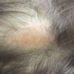 Scalp Psoriasis Treatment: Finding Relief for Your Itchy, Flaky Scalp